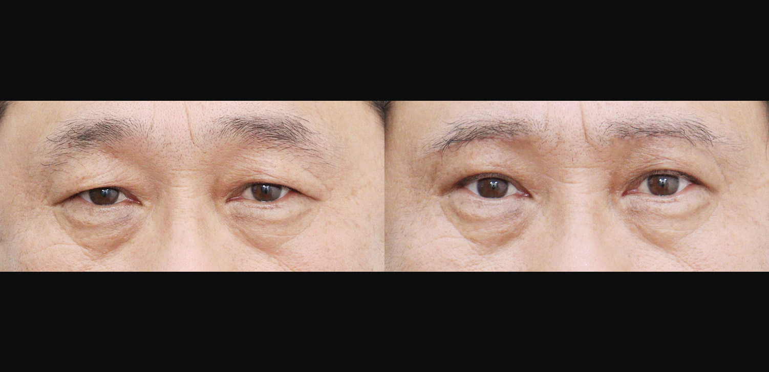 눈썹하거상술